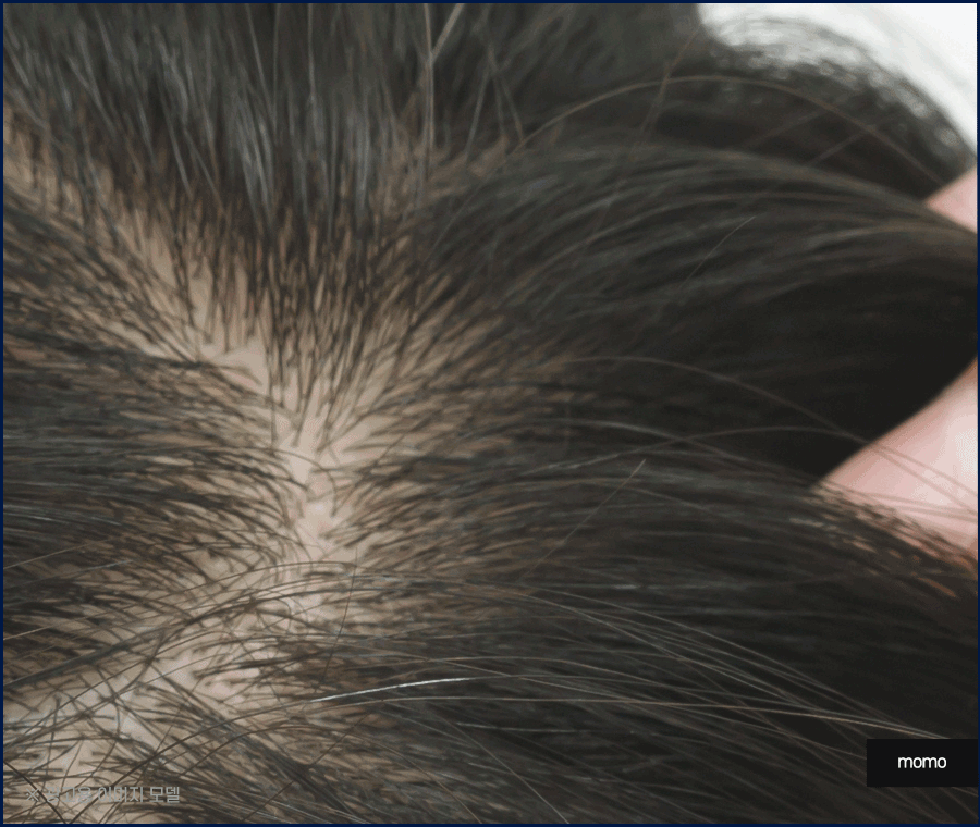 여자 정수리 탈모 초기 증상 및 머리카락빠짐 대응 방안 관련 이미지 7