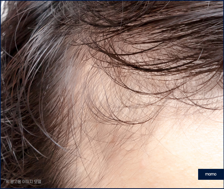 엠자이마 고민 탈출을 위한 모발이식 관련 이미지 3