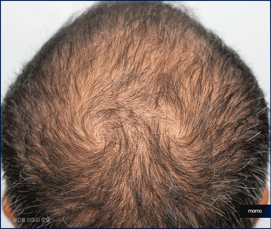 전두탈모 원인 보강을 위한 현명한 선택은? 관련 이미지 9