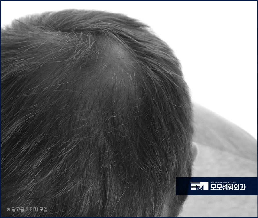 비절개모발이식가격 꼼꼼히 살펴보며 함께 체크할 점 관련 이미지 3