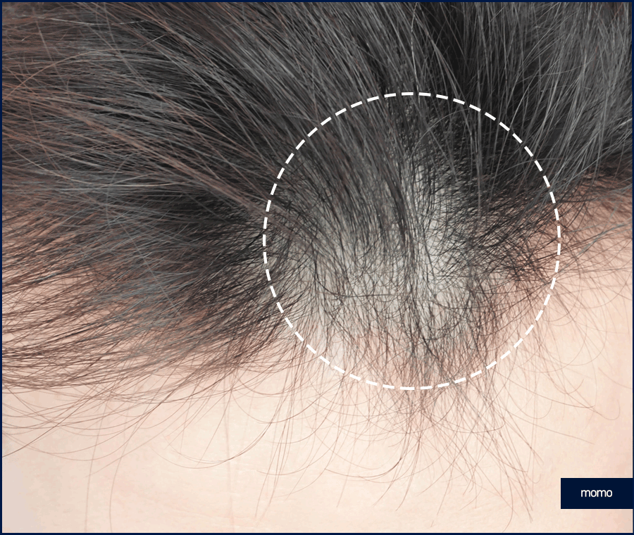 앞머리 모발이식 비용 개인에 따라 달라지는 이유 관련 이미지 4