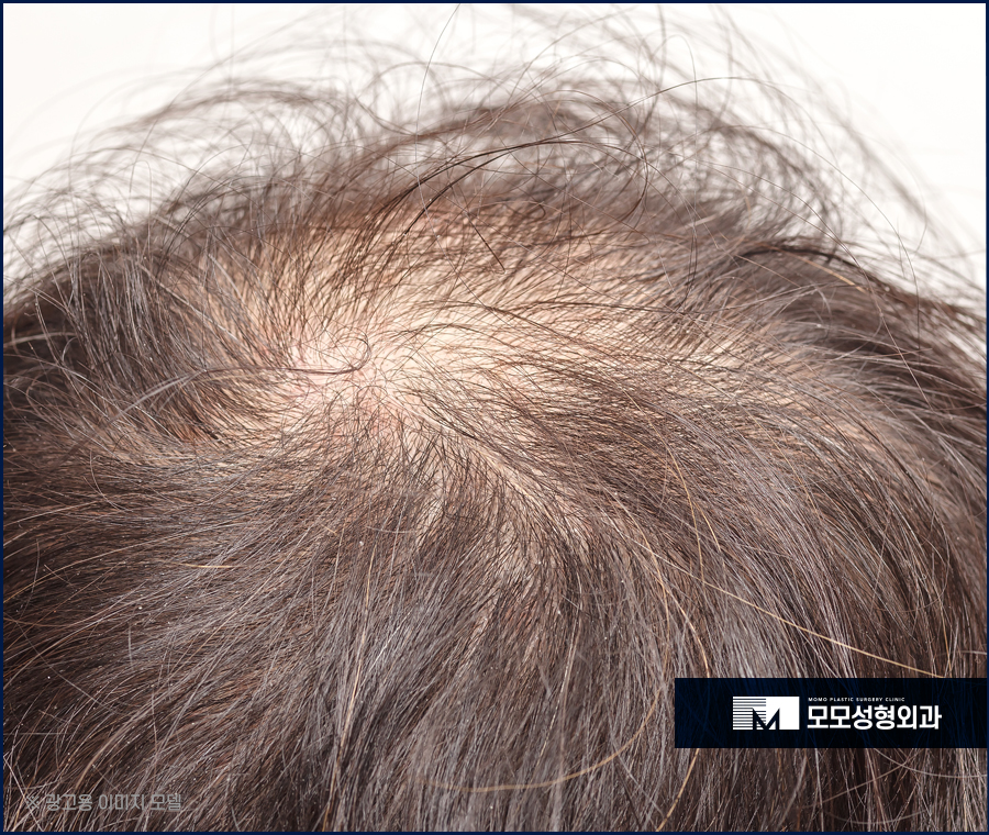 모발이식병원추천 중요한 기준에 대해 관련 이미지 4