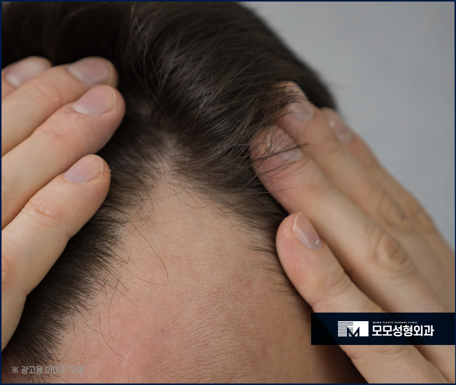 남자 앞머리 탈모 M자 라인 깊어짐이 보인다면 관련 이미지 5
