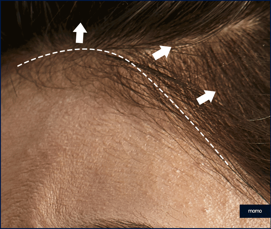 남자헤어라인모발이식 디자인의 중요성 관련 이미지 5