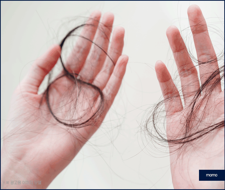 모발이식전후 확인 중이라면 꼭 체크할 핵심 요소 관련 이미지 2