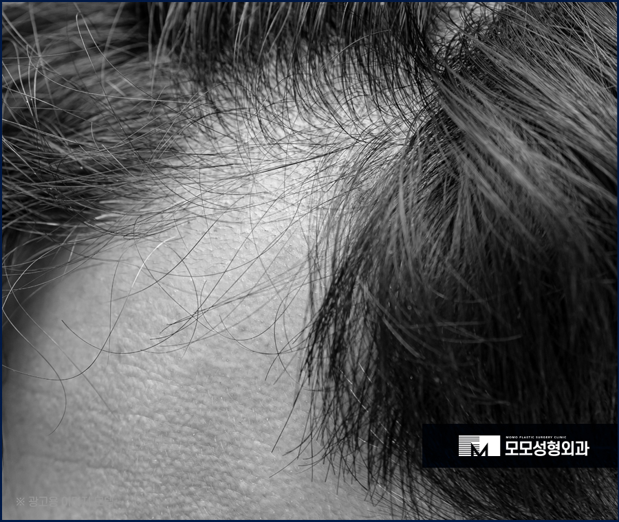 여자 헤어라인 모발이식 부작용 발생 우려를 낮춰야만 관련 이미지 6