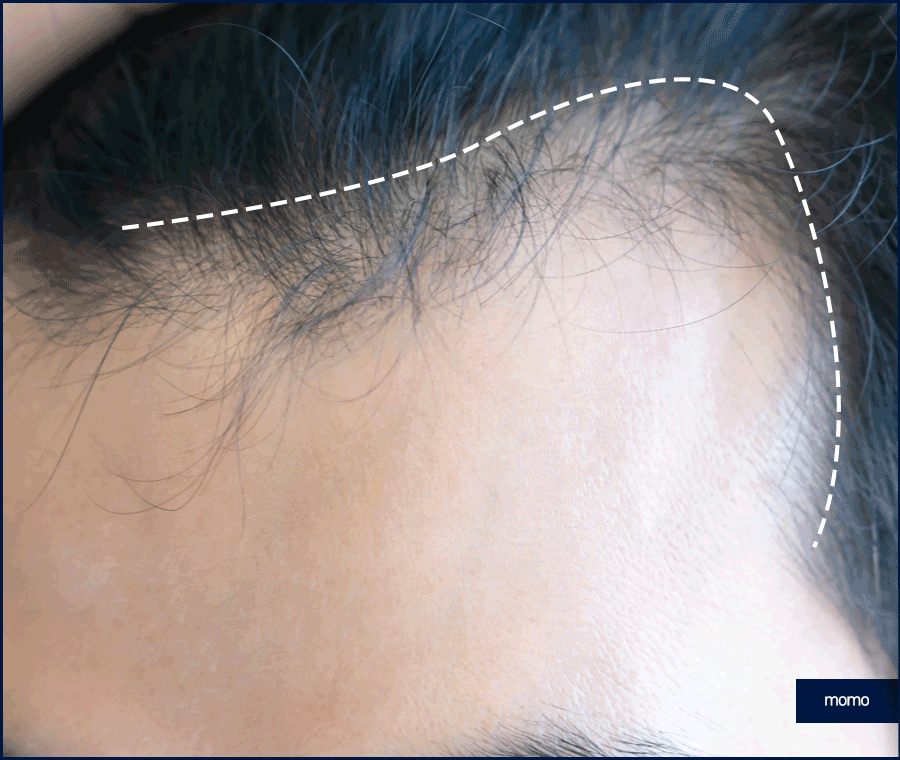 남자 모발이식 비용, 방법까지 꼼꼼히 확인하세요! 관련 이미지 5