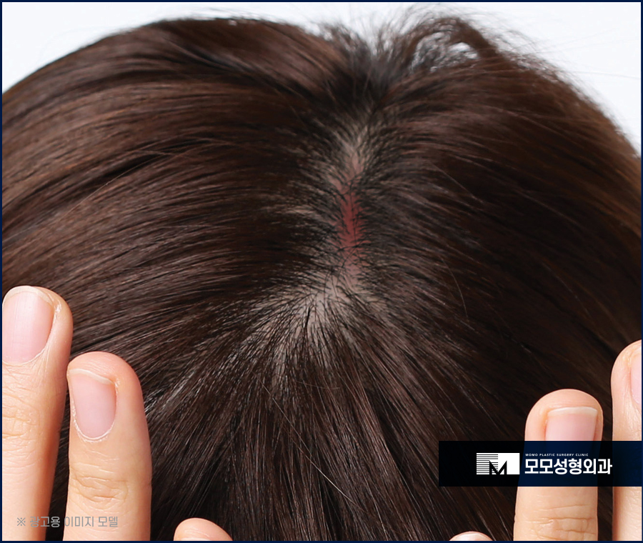 두피뾰루지원인 부터 조치하는 방법은 관련 이미지 5