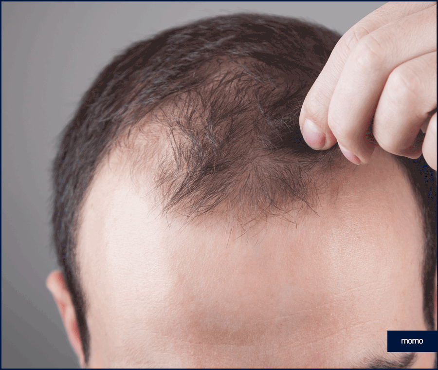 엠자탈모 약 진단과 처방으로 효과보기 위한 관련 이미지 4