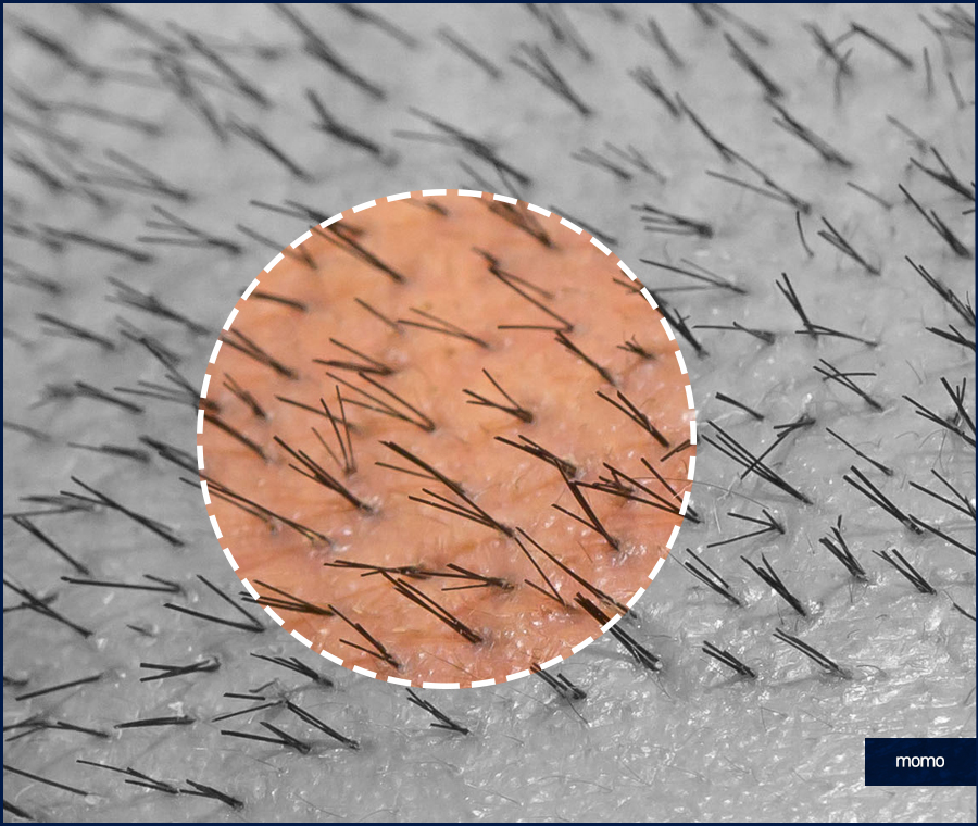 모발이식3000모비용 차이나는 이유 관련 이미지 7