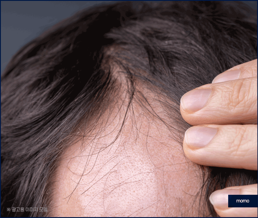 머리심기 비용 및 시술별 장단점 알아보기 관련 이미지 5
