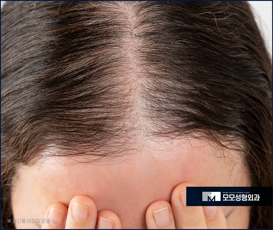 여자가르마탈모 숱을 채워가는 방향으로 관련 이미지 2