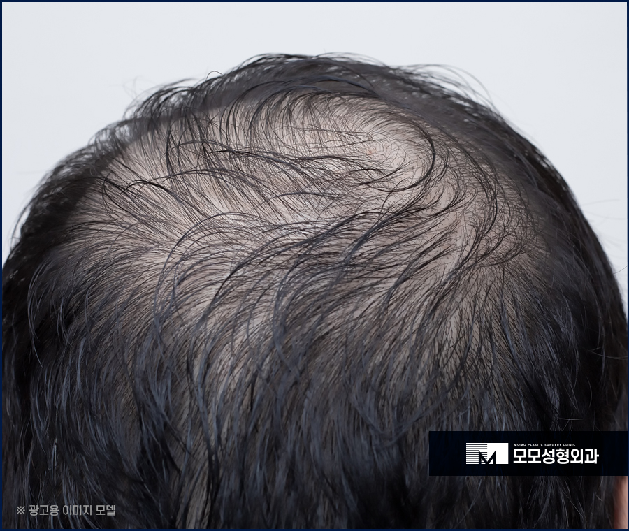 윗머리탈모 촘촘히 채워 고민을 탈출하는 관련 이미지 3