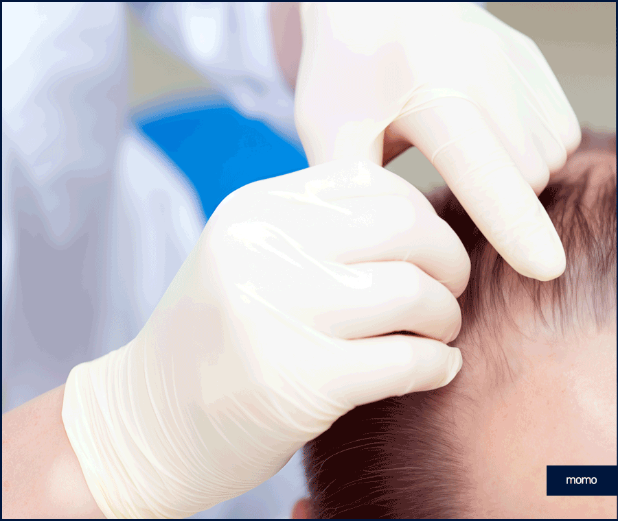 모발이식재수술 원인 및 성공을 위한 핵심 2가지 관련 이미지 6