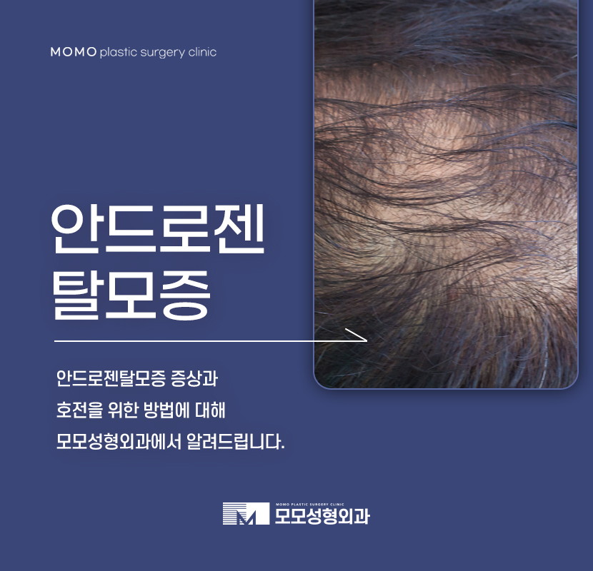 안드로젠탈모증 증상과 호전을 위한 방법은 관련 이미지 1