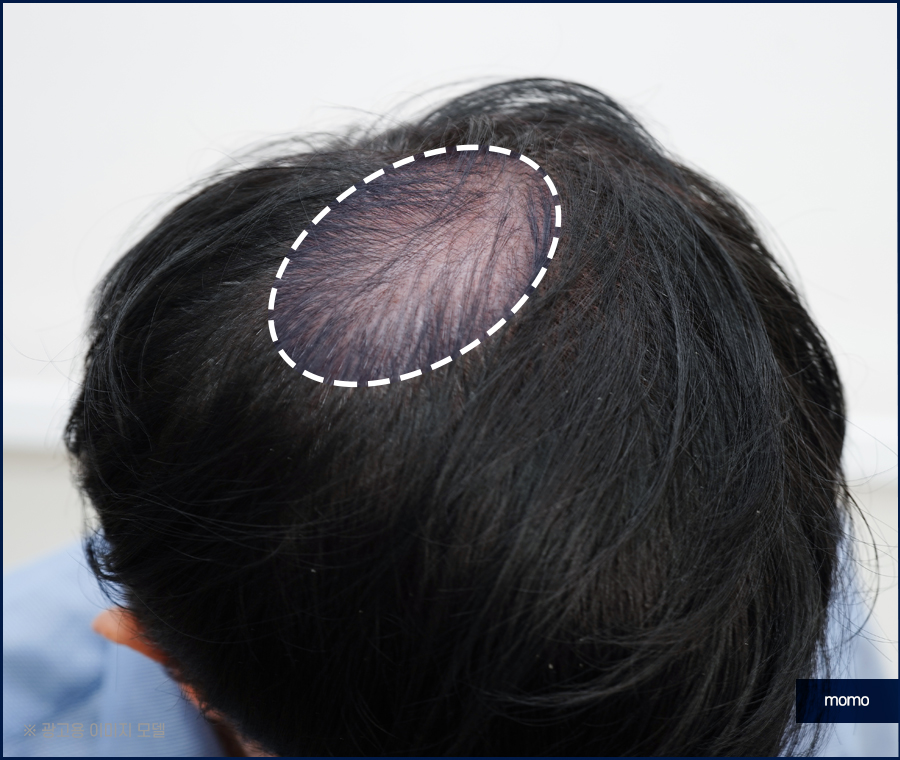 스트레스성 원형탈모를 유발하는 원인은 관련 이미지 5