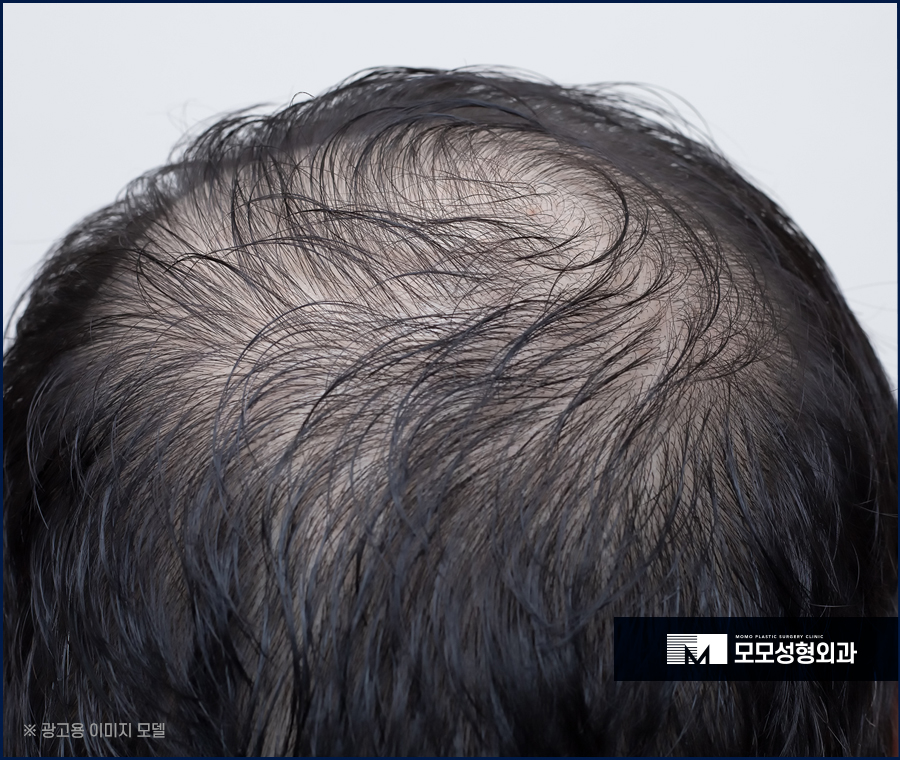 모발이식생착률 높일 수 있는 방법 관련 이미지 6