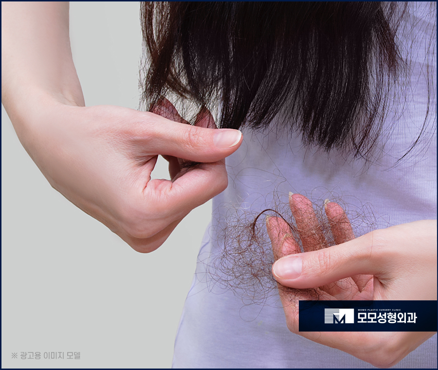 여성 헤어라인 모발이식 미모까지 완벽해 지는 효과 관련 이미지 5