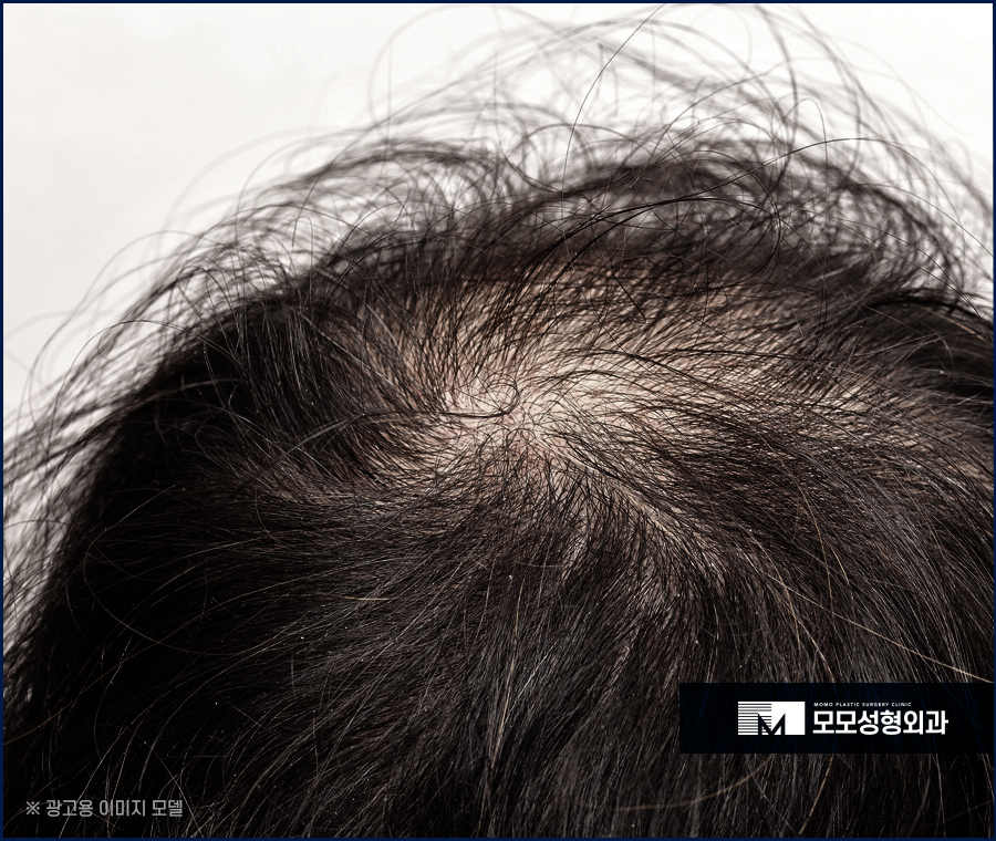 서울모발이식 고려하고 있다면 꼭 확인할 점은 관련 이미지 2