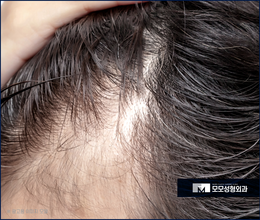 강남역 모발이식 빈 곳을 채우며 풍성하게 관련 이미지 7