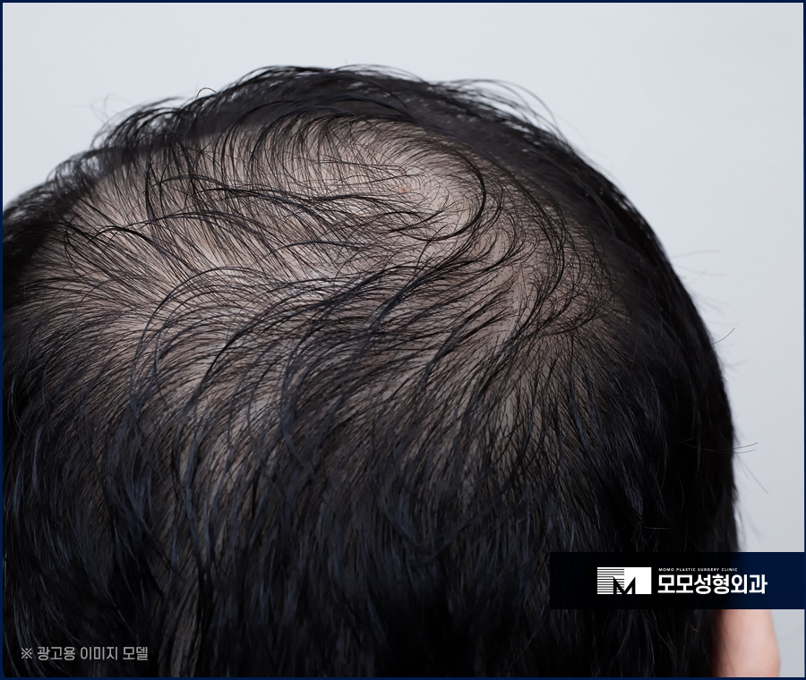 연모화 증상 원인과 방치에 대한 위험성까지 관련 이미지 2