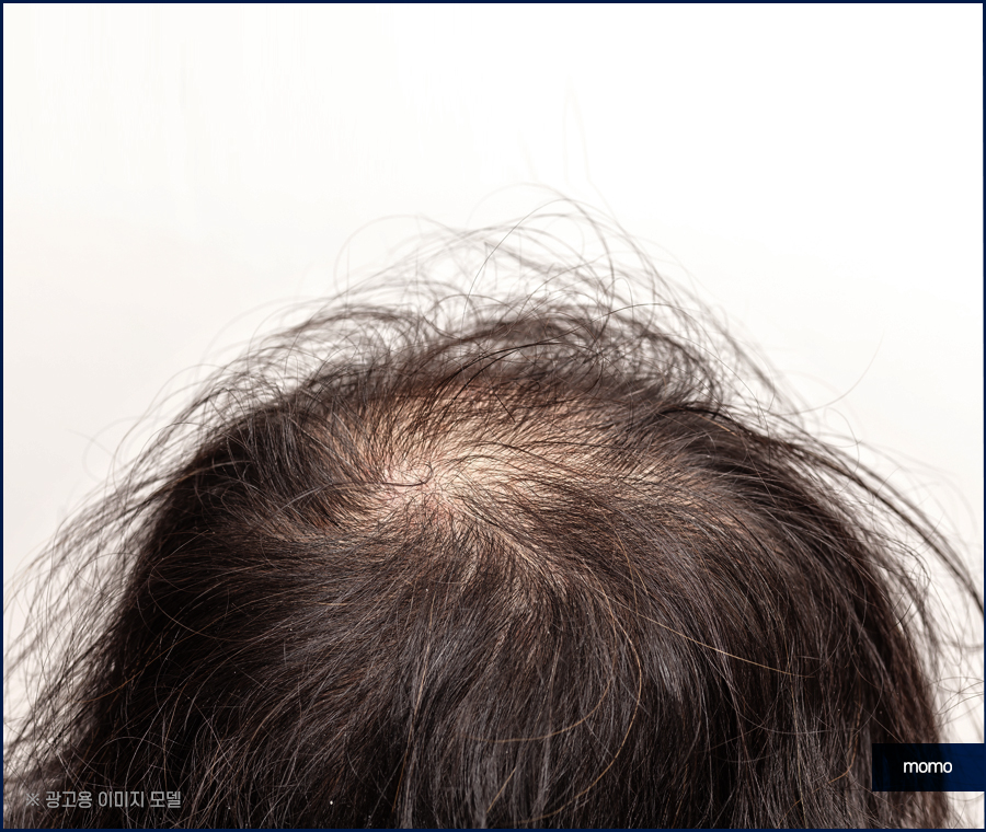 앞머리 모발이식 가격 차이부터 확인하며 관련 이미지 7