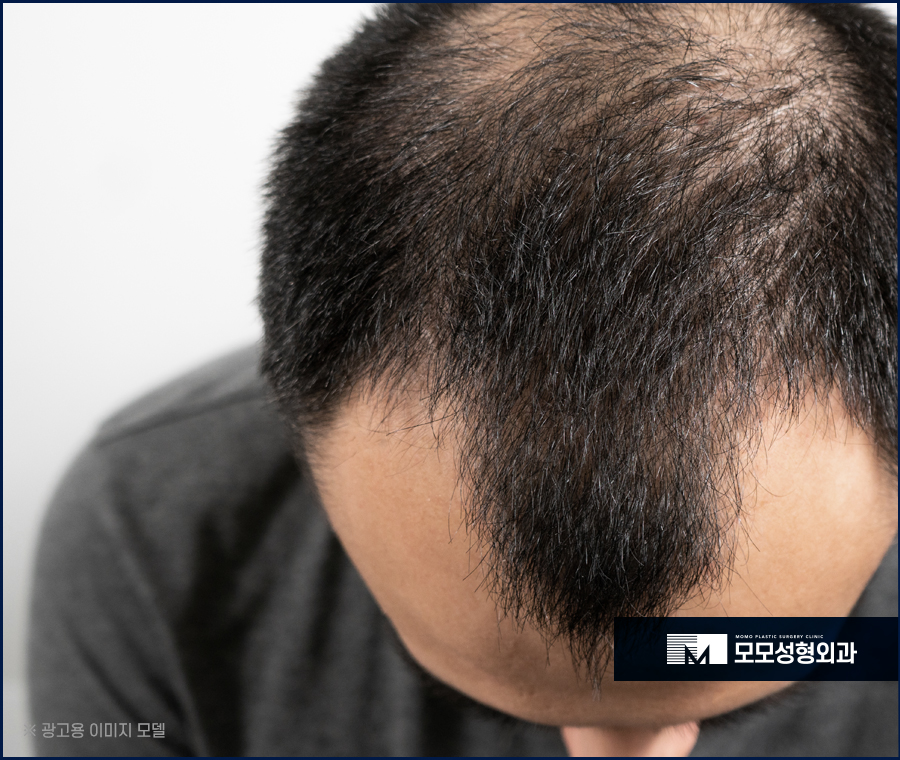 서울 모발이식 오랜 고민을 이겨내기 위한 선택 관련 이미지 5