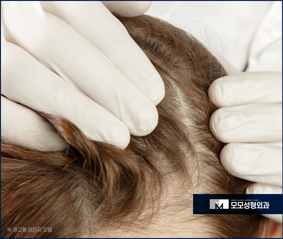 미녹시딜부작용 미리 알고 올바르게 관련 이미지 3