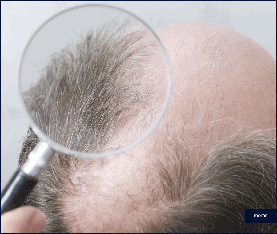 강남 모발이식 성공적인 변화를 만드는 꿀팁 관련 이미지 7