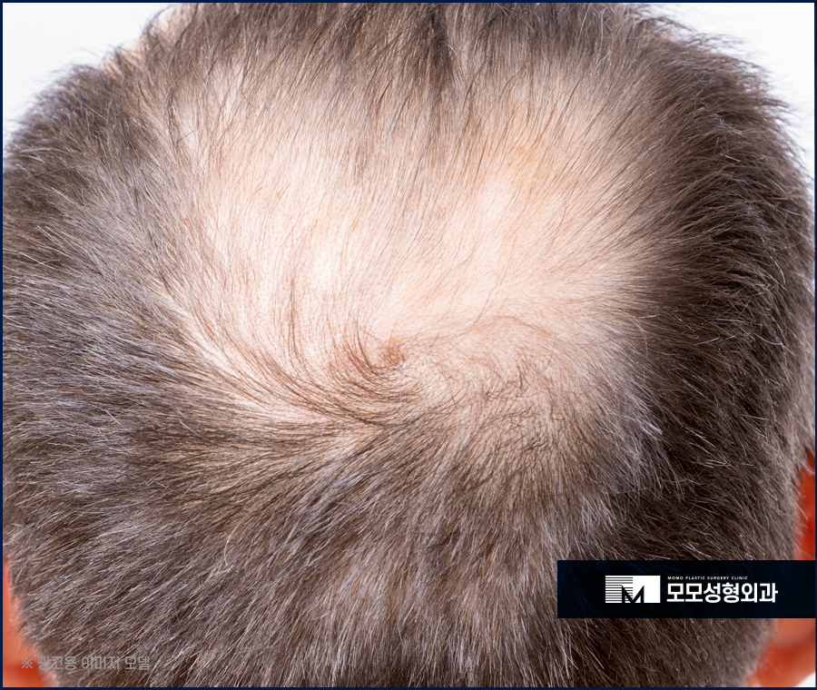 m자탈모모발이식비용 어느 정도가 적절할까요 관련 이미지 5