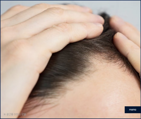 헤어라인 교정 비용 및 방법 디자인의 중요성 관련 이미지 5
