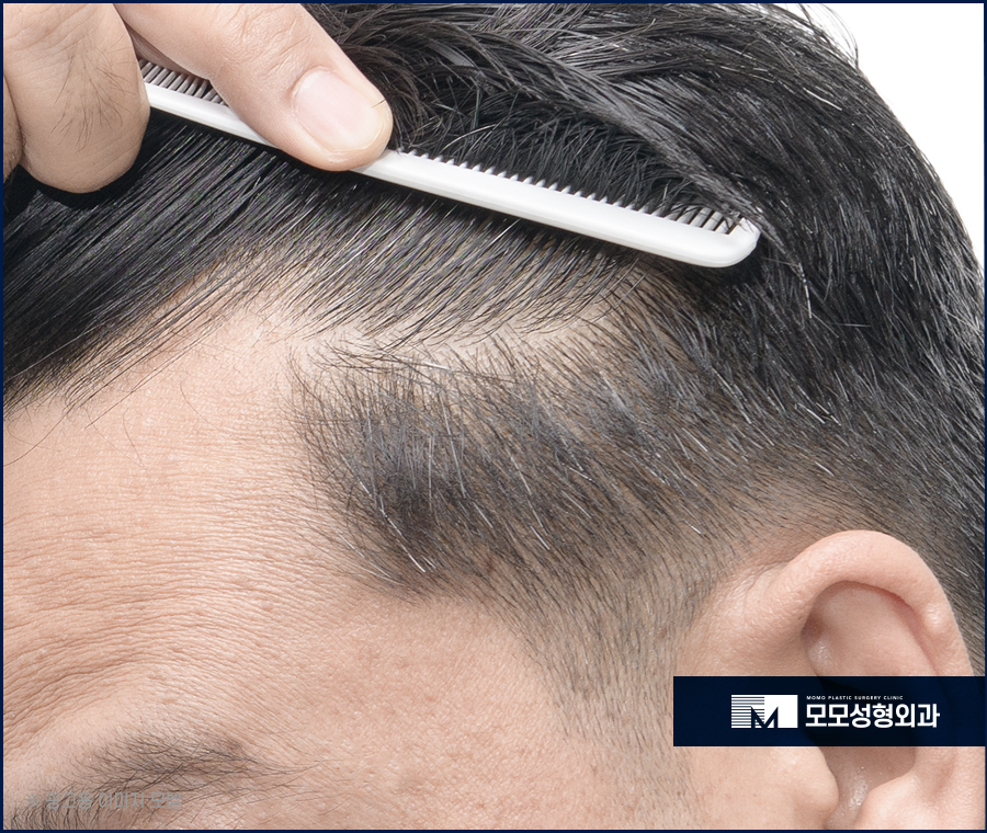 서울 모발이식 오랜 고민을 이겨내기 위한 선택 관련 이미지 8