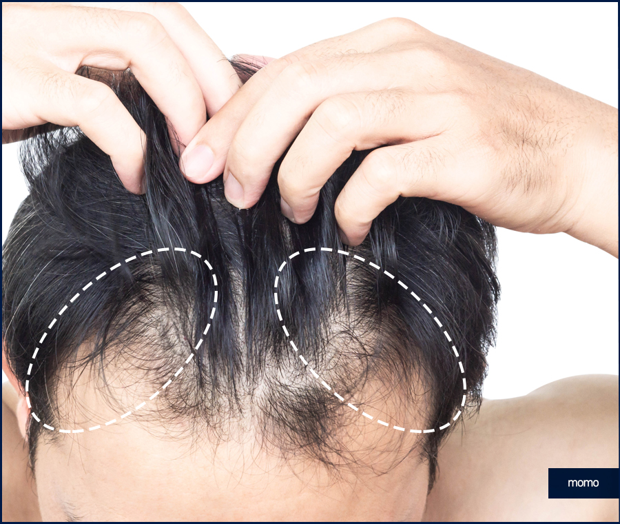 모발이식잘하는곳 찾는 결정적인 기준 관련 이미지 10