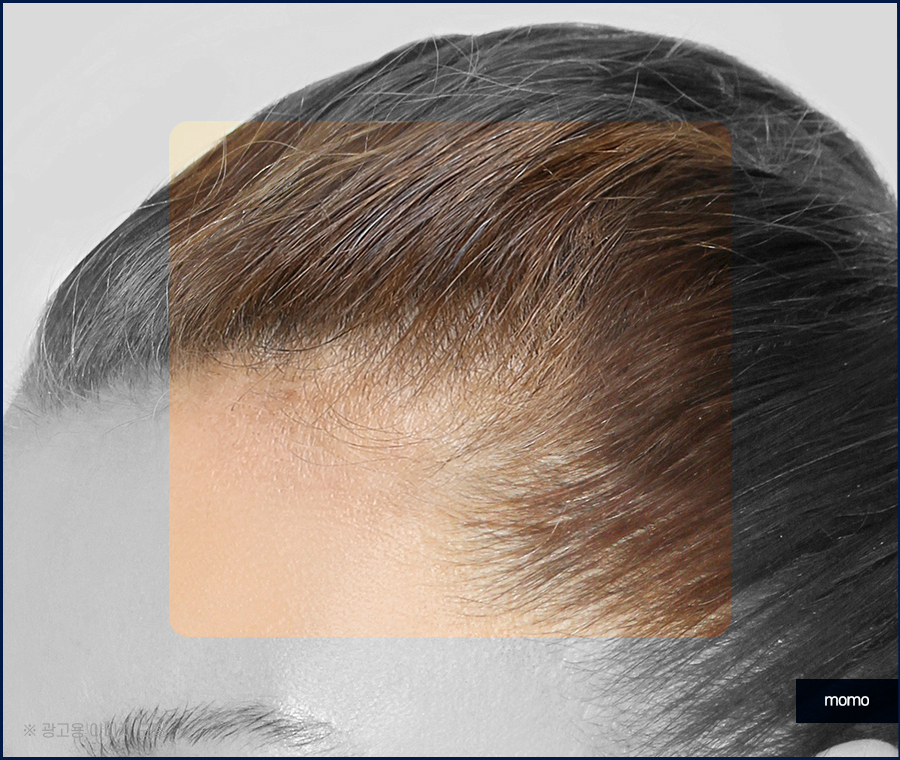 여자 M자 탈모 자연스럽게 채워가는 관련 이미지 6