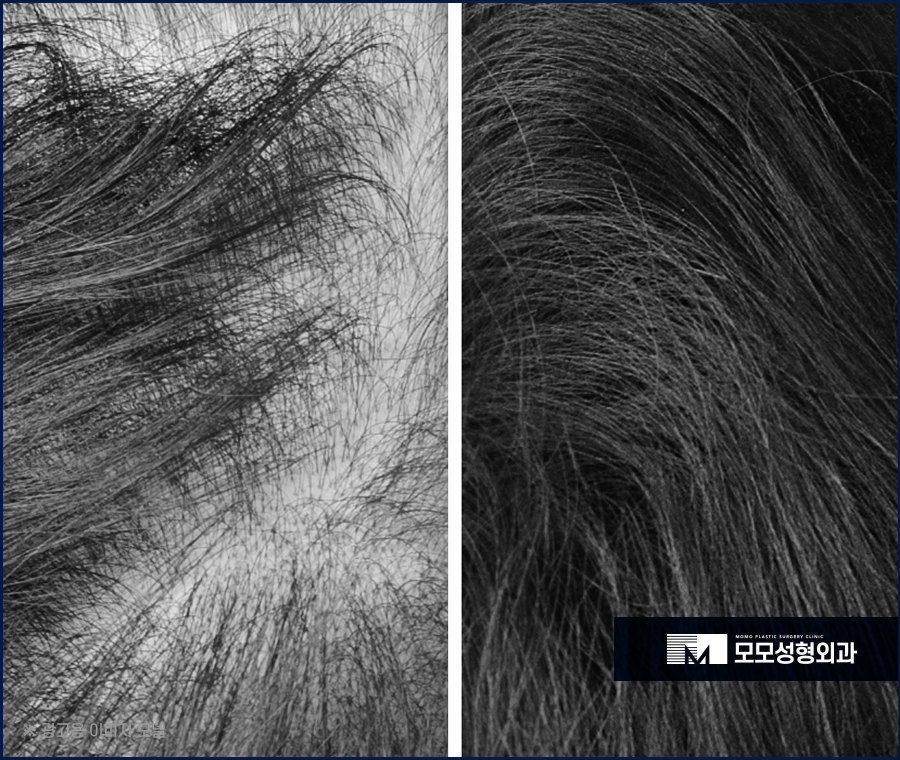 모발 얇아짐 이유와 두께를 복구하는 방법 관련 이미지 3