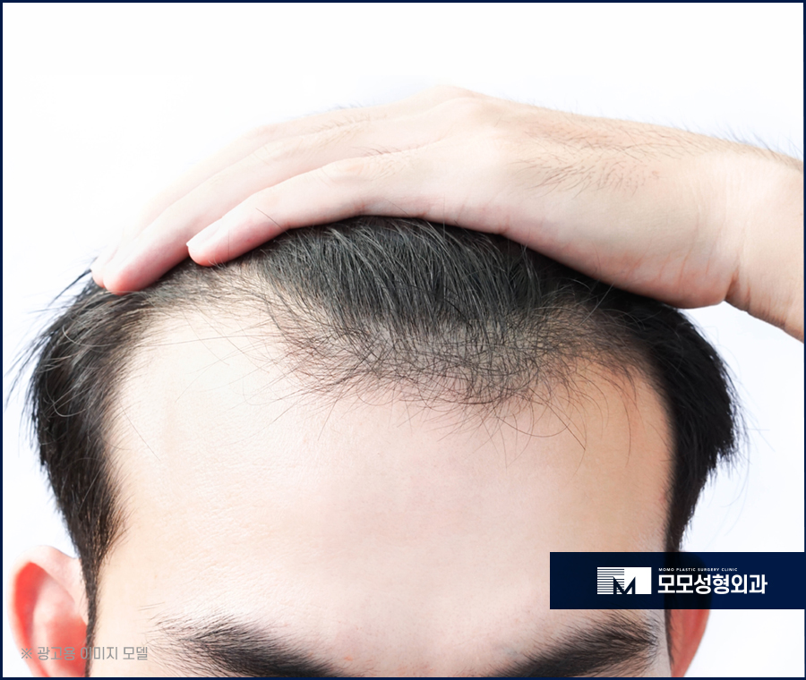 20대정수리탈모초기 신속한 대응이 중요합니다 관련 이미지 4