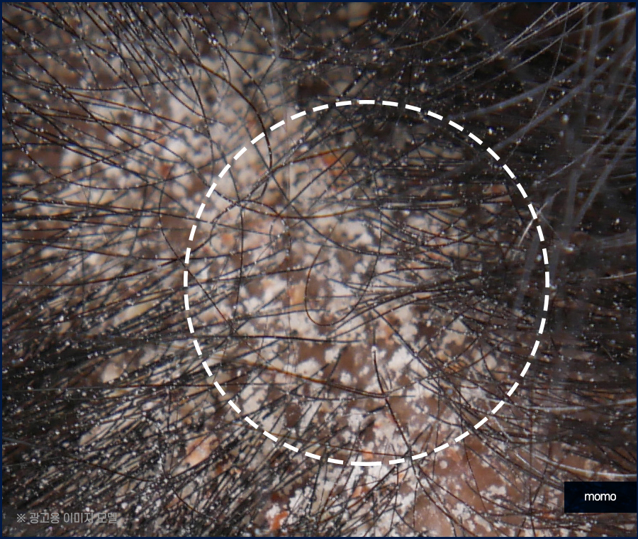 머리 간지러움 원인과 빠른 증상 해소를 위한 tip 관련 이미지 3
