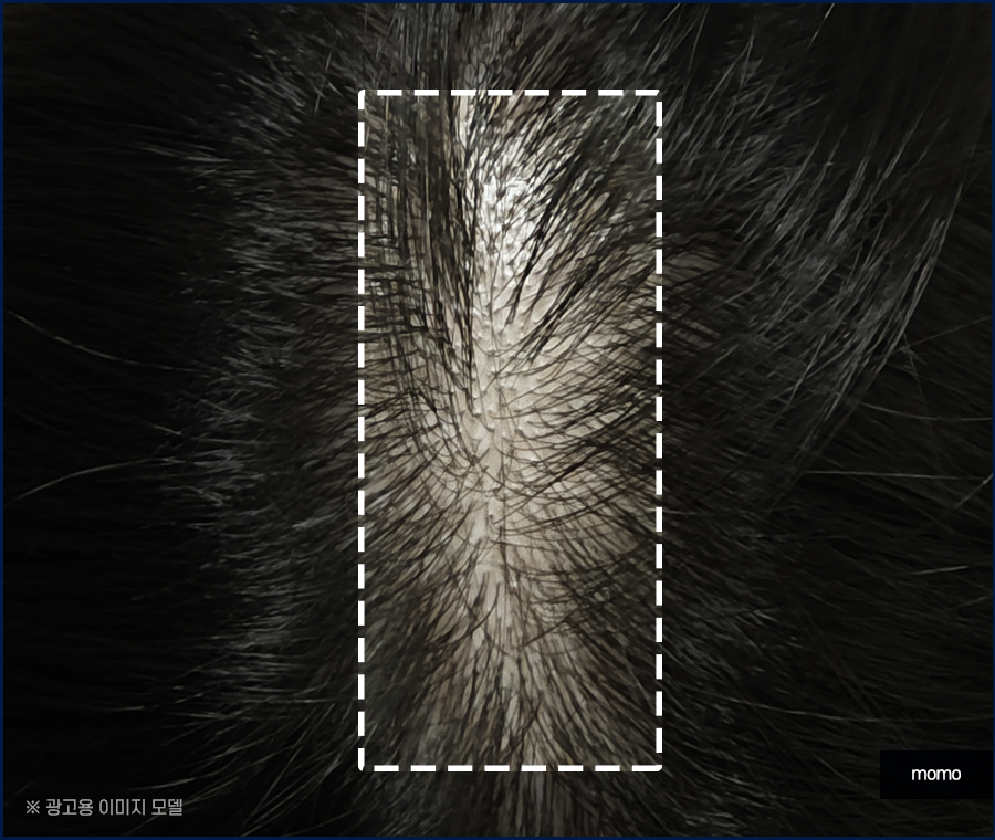 20대 원형탈모 효과적인 개선 방법은 관련 이미지 7