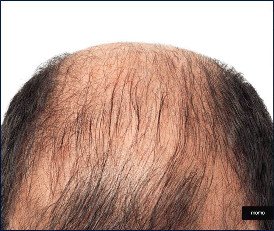 모발이식전후 확인 중이라면 꼭 체크할 핵심 요소 관련 이미지 10