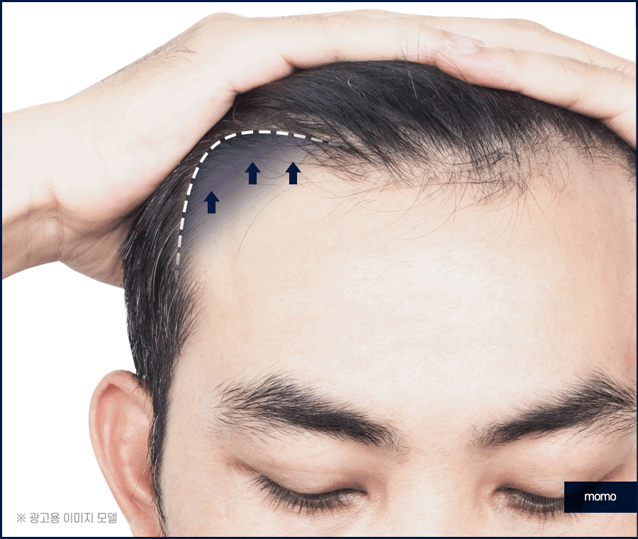 모발이식전후 확인 중이라면 꼭 체크할 핵심 요소 관련 이미지 3