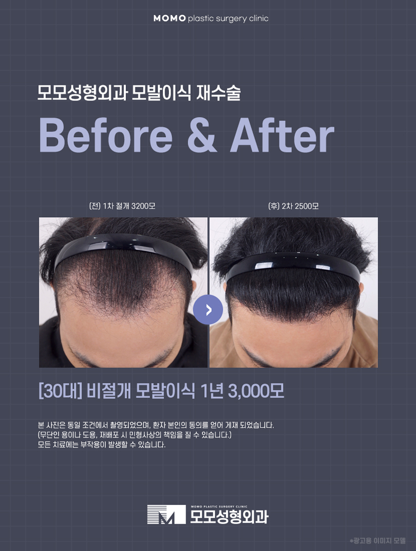 모발이식 재수술 실수가 다시 나타나지 않는 방향으로 관련 이미지 6