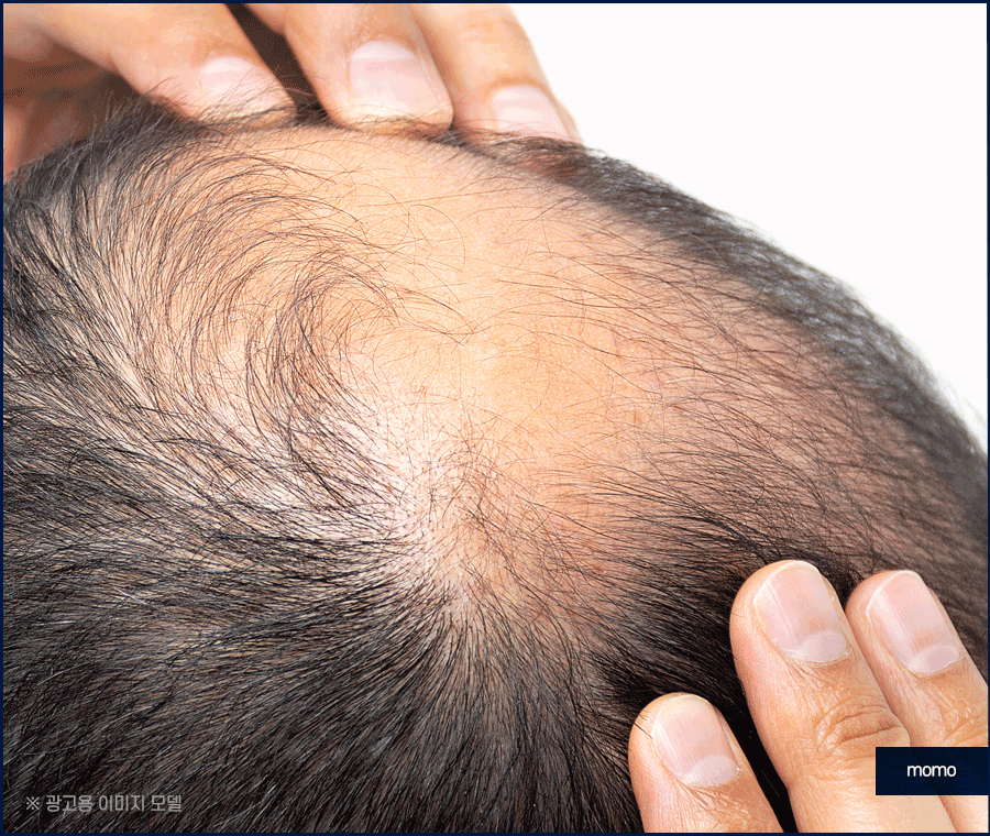 탈모약 처방 및 주의사항, 회복을 위한 대안 관련 이미지 7