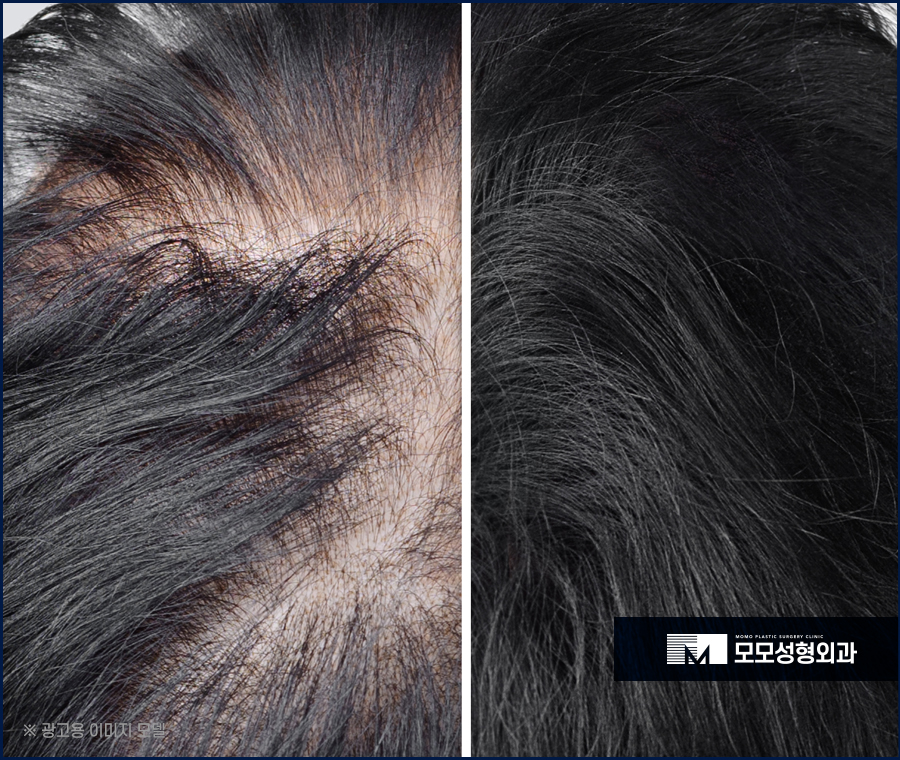 모발 얇아짐 심각성을 알고 경각심을 가져야만 관련 이미지 3