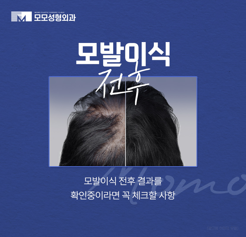 모발이식전후 확인 중이라면 꼭 체크할 핵심 요소 관련 이미지 1