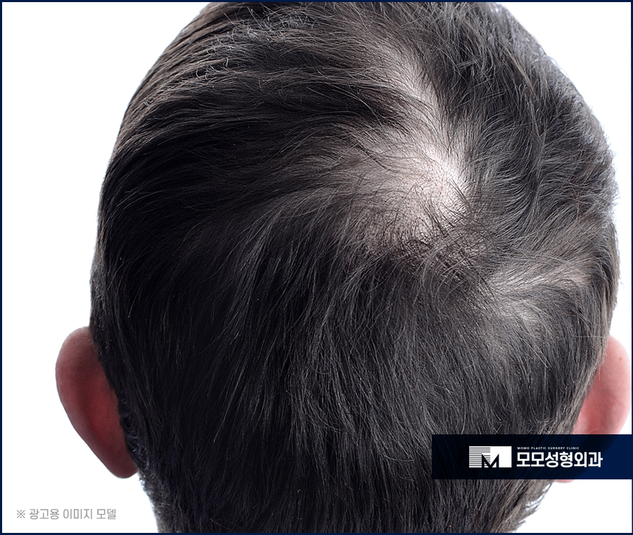 정수리탈모병원 분석부터 꼼꼼하게 하는 곳에서 관련 이미지 4