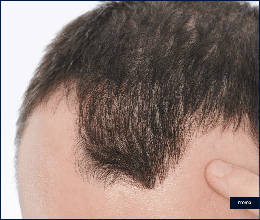 탈모 클리닉 비용의 기준이 되는 조건은? 관련 이미지 5