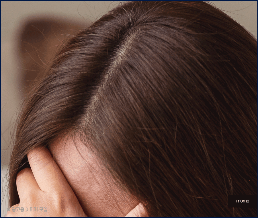 엠자이마 탈모 헤어라인 모발이식으로 관리하기 관련 이미지 4