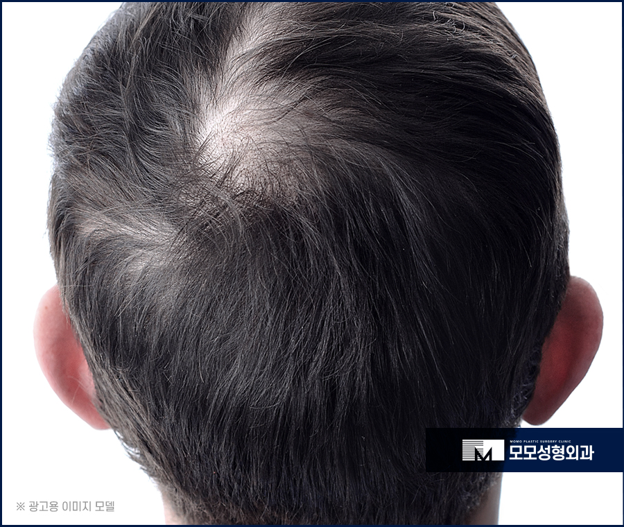 무삭발모발이식 빠른 회복을 위한 선택 관련 이미지 3
