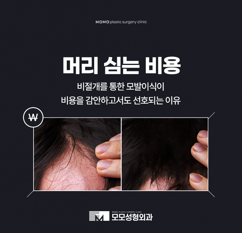 머리심는비용 비절개가 선호되는 이유에 대해 관련 이미지 1