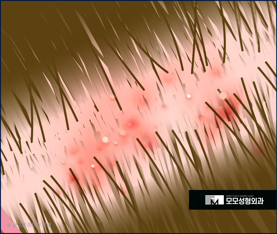 두피모낭염 증세와 해결 방법에 대해 관련 이미지 2
